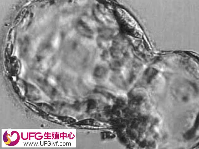 移植一个胚胎有可能变成双胞胎